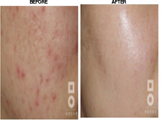 Miall Korean Medicine Clinic (Gangnam) before-after