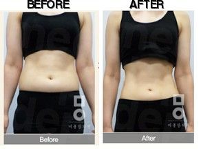 Miall Korean Medicine Clinic (Gangnam) before-after