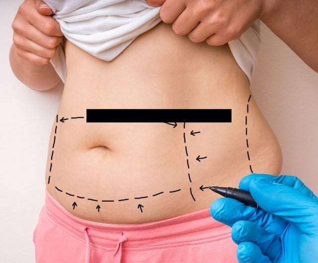 Best Liposuction Clinics in Seoul