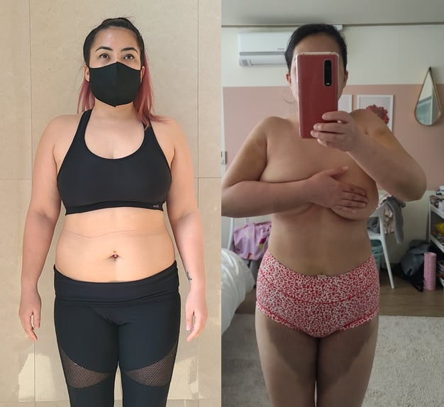 I Got Liposuction in Korea | A Full Review of My Liposuction Experience (Consultations, Price, Before After, etc)