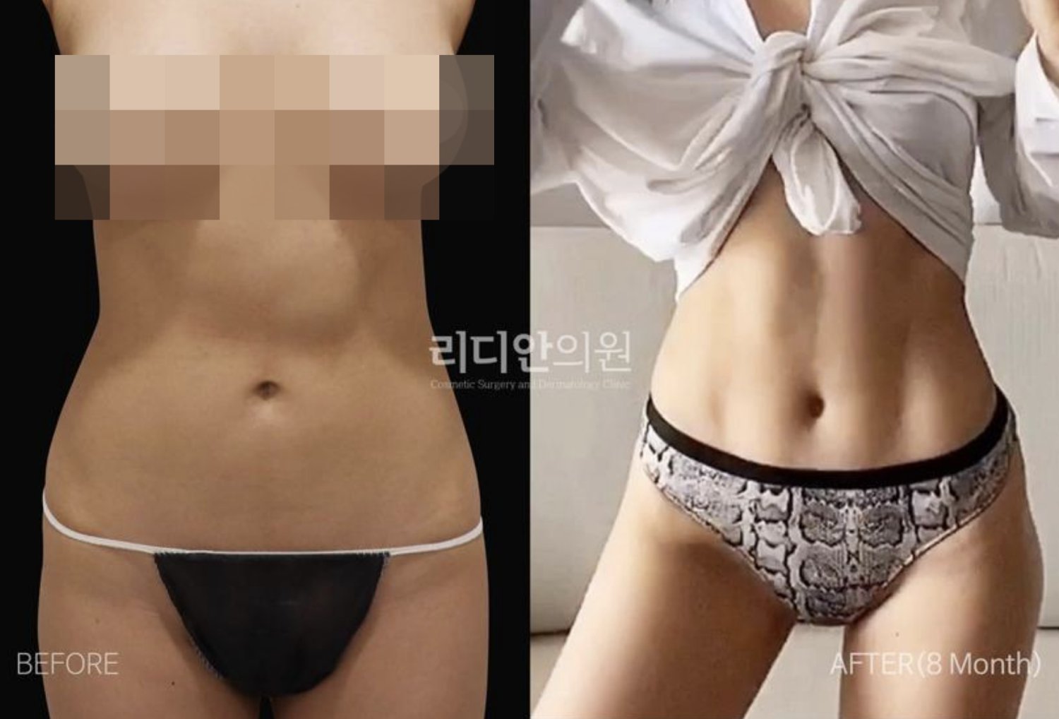 liposuction in korea
