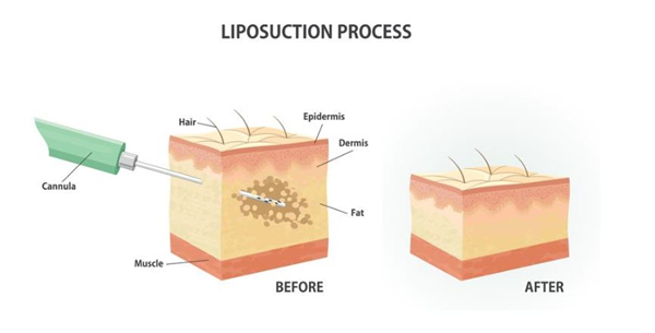 How much is a thigh liposuction cost