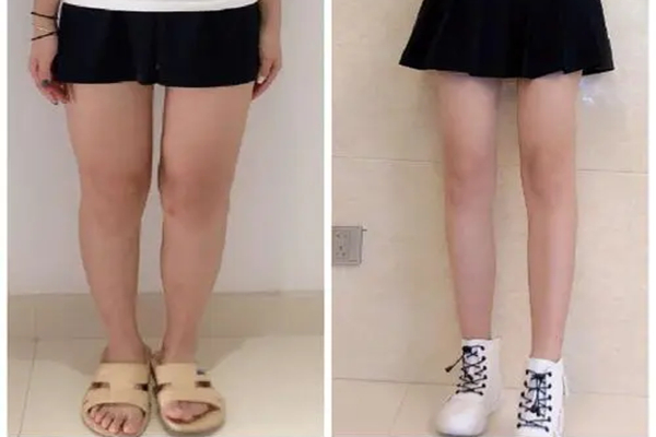Thigh  liposuction before and after