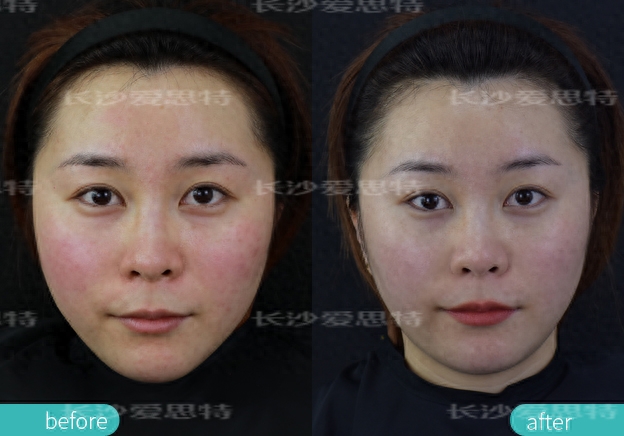 M22光子嫩肤是小红书上最热门的激光美肤项目。