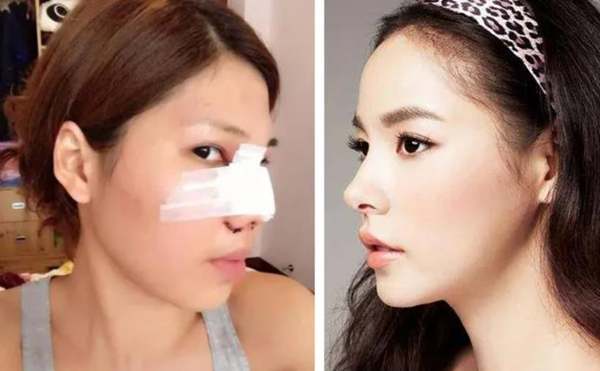 Nose Surgery