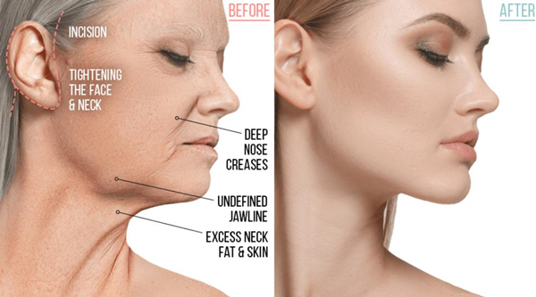 Korean facelift