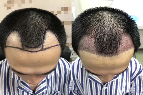 Hair Transplant