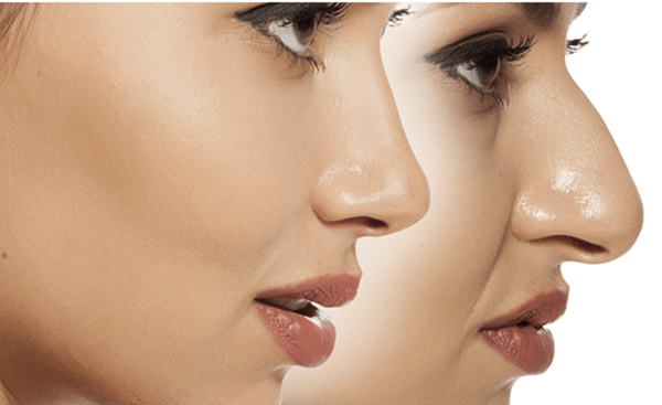 Rhinoplasty