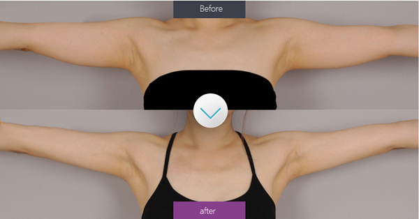 arm liposuction