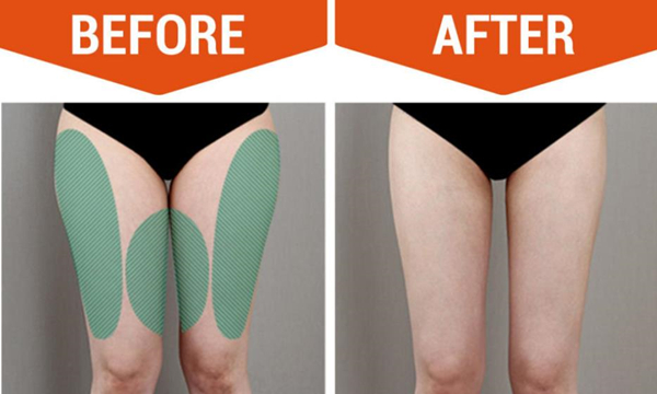 thigh liposuction 