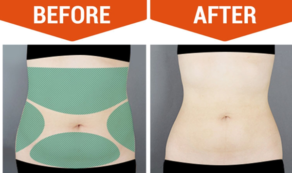 abdominal liposuction before and after