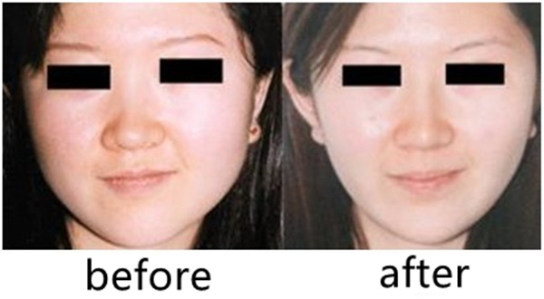 face liposuction