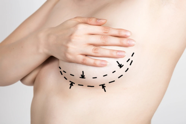 How much does a breast lift cost