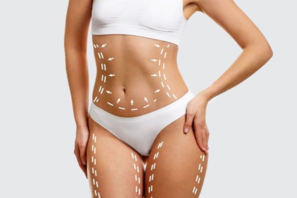 Tummy Tuck