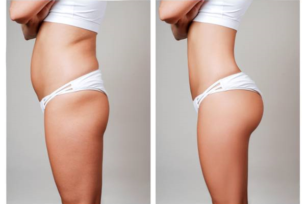 Liposuction