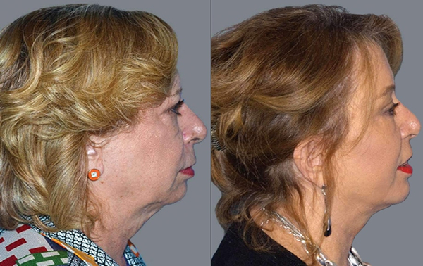 What is the best age for a facelift