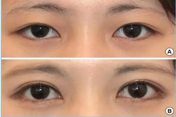 eye surgery