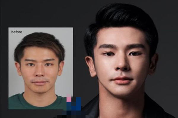 Face Liposuction in Korea for Males