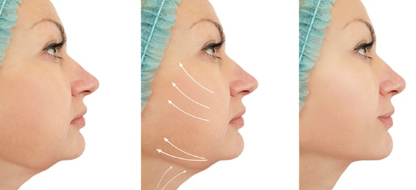 What is Face Liposuction?