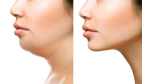 Face Liposuction Cost