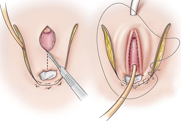 How does a Vaginoplasty Work