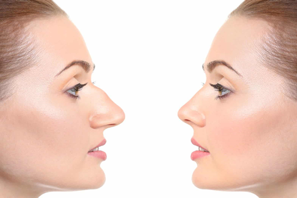 Rhinoplasty