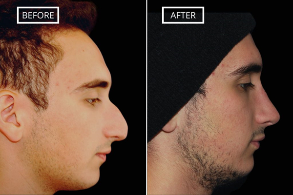 Korean Rhinoplasty Before and After