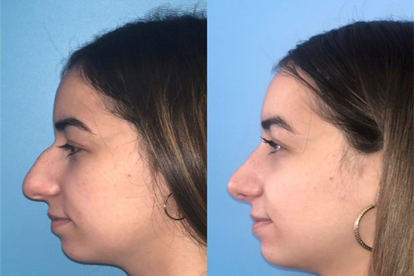 Rhinoplasty Cost