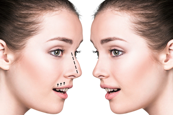 rhinoplasty