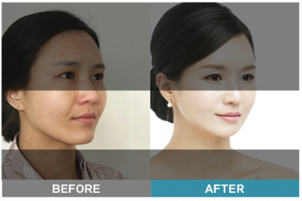 bone contouring before and after