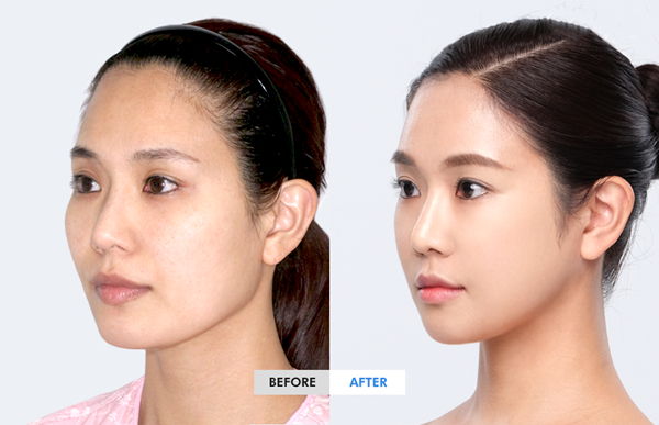 cheekbone reduction before and after