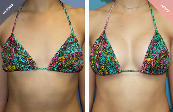 breast augmentation