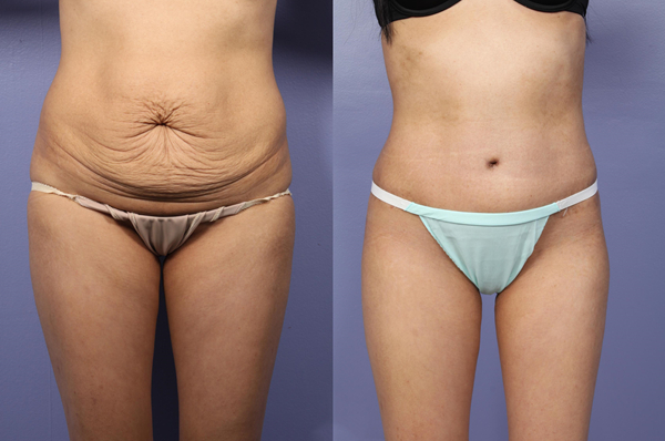 abdominal liposuction in Korea