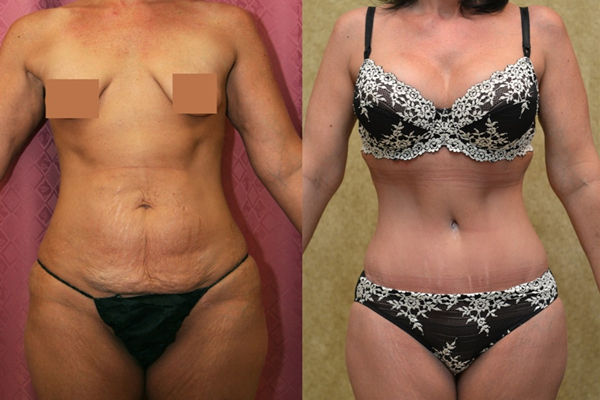 Is Abdominoplasty Right for me? 