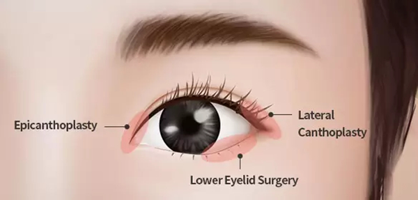 Types of Double Eyelid Surgery