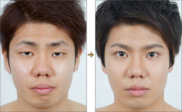 Korean Double Eyelid Surgery Before & After