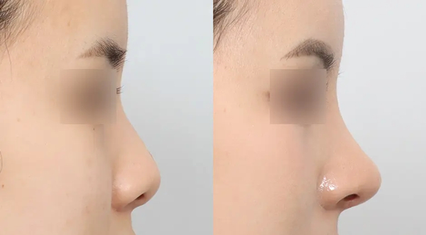 What is Short Nose Surgery in South Korea?