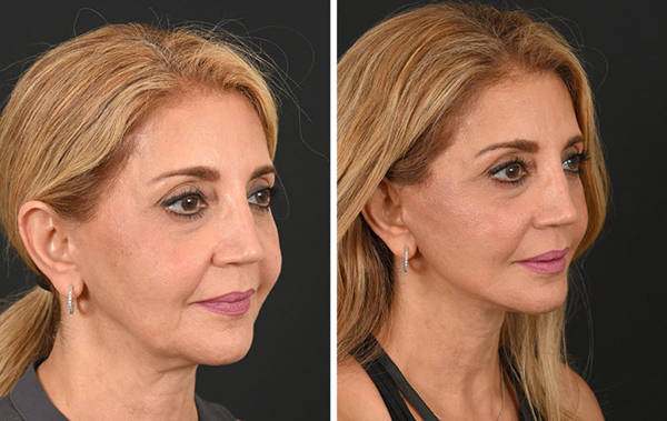 What Is the Best Age to Get a Facelift? 