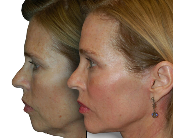 What is the Facial Fat Grafting procedure like? 