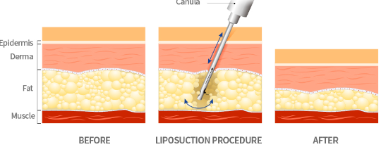 How much does liposuction cost in Korea?